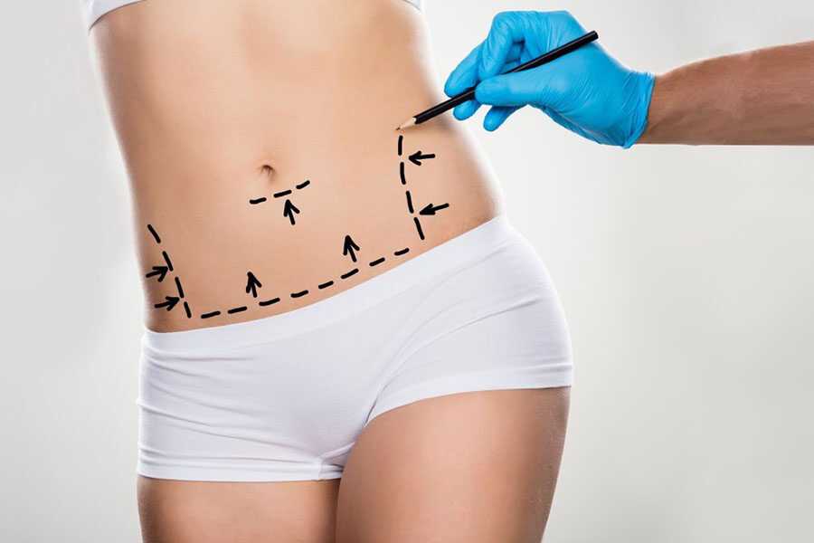 layanan bedah - Abdominoplasty