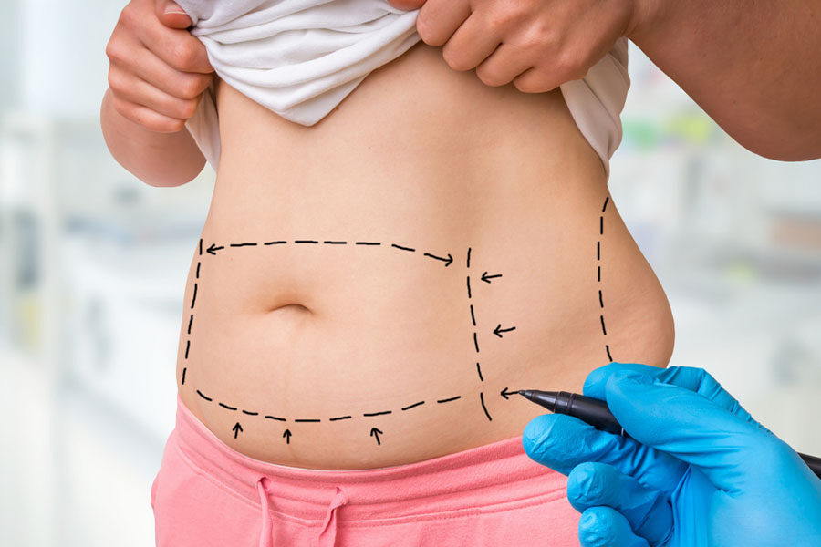 layanan bedah - Tummy Tuck